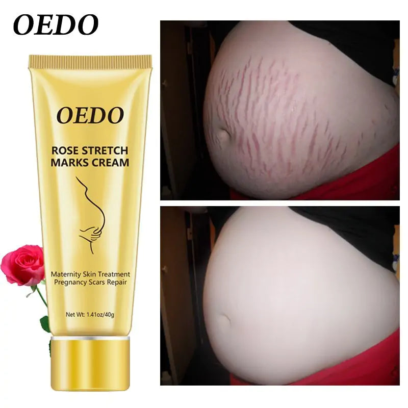 oedo stretch mark cream review