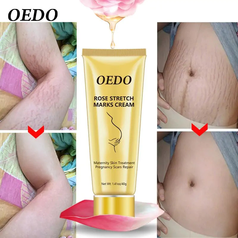 OEDO Stretch Mark Cream