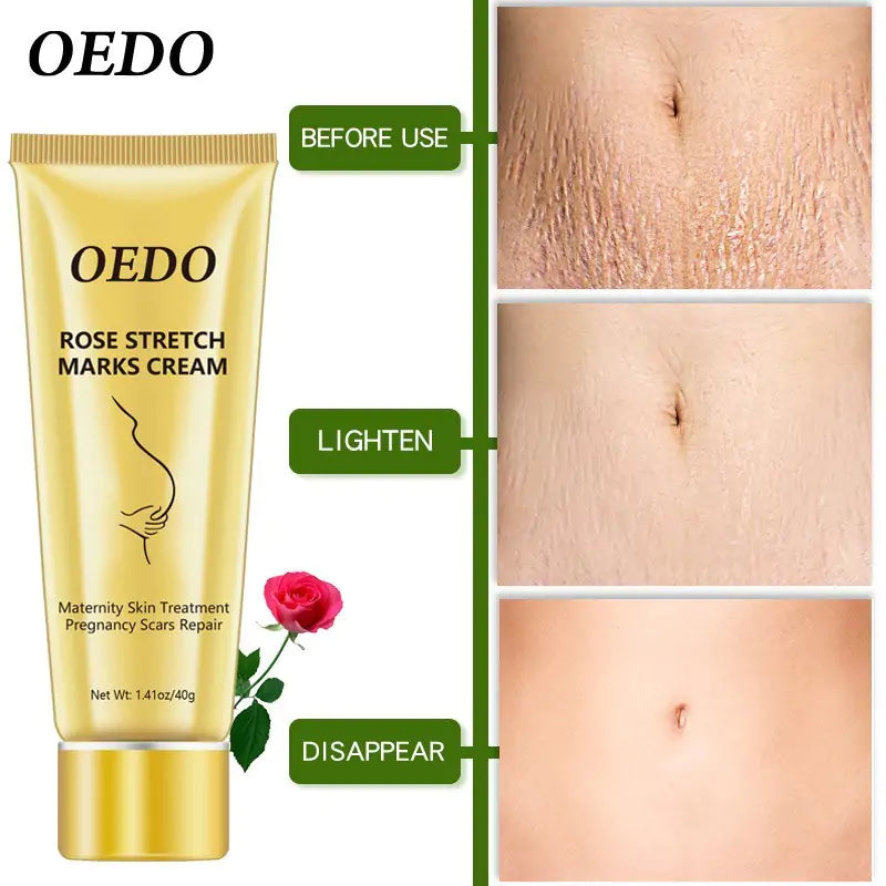 OEDO Stretch Mark Cream